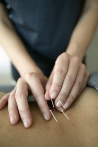 acupuncture